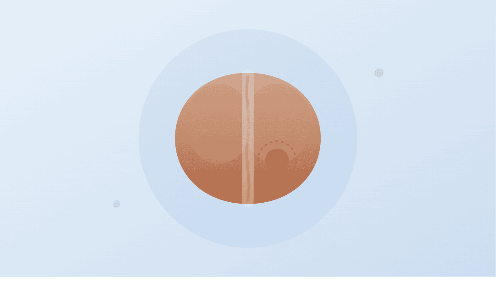 Prostate cancer