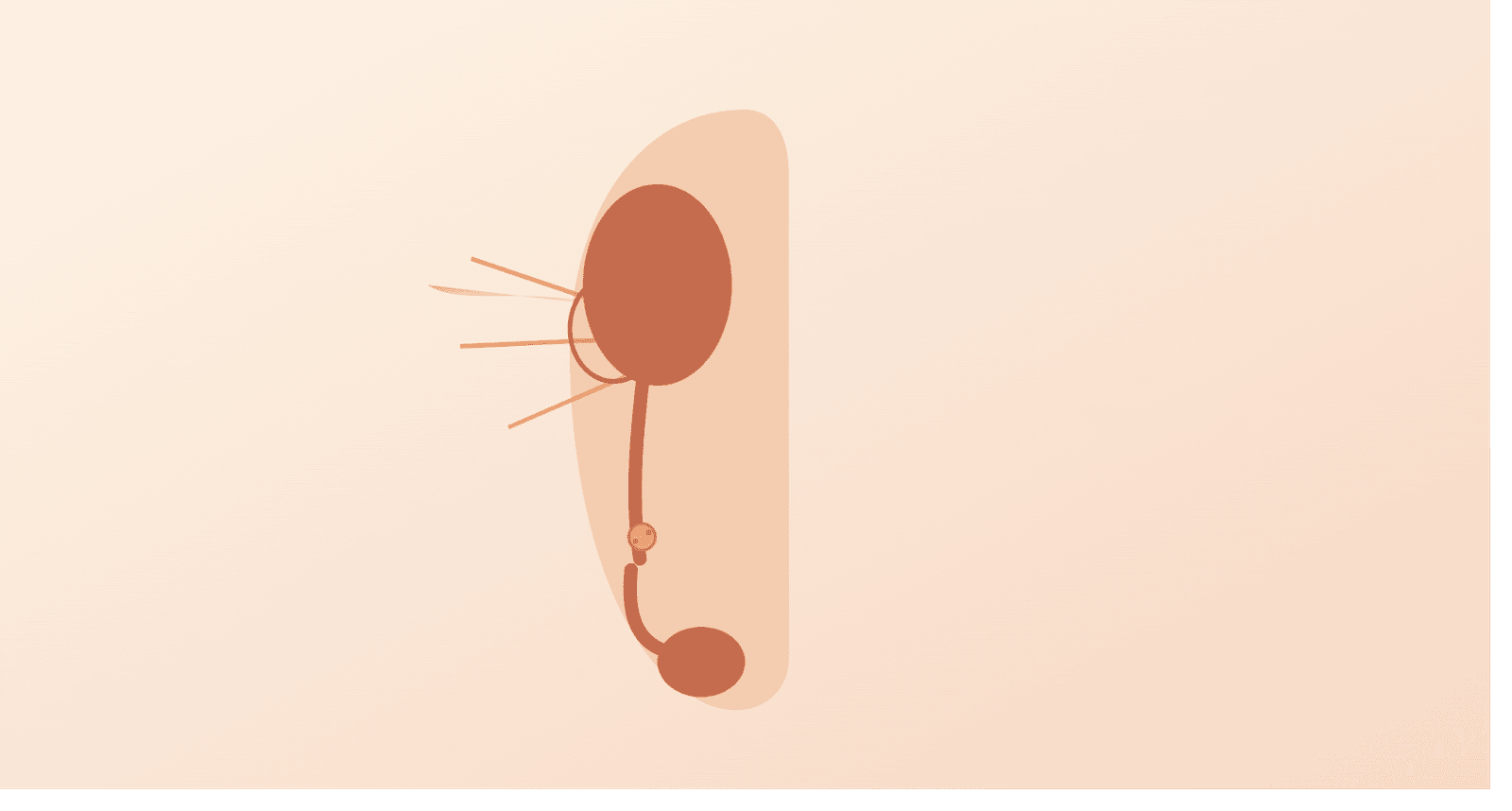 Ureteral stone (Stone in the tube from kidney to bladder): Home Guide