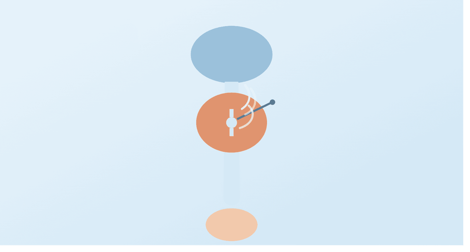 Rezum (water vapour/steam therapy) for enlarged prostate